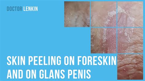 glans discoloration pictures|loose skin on penis shaft.